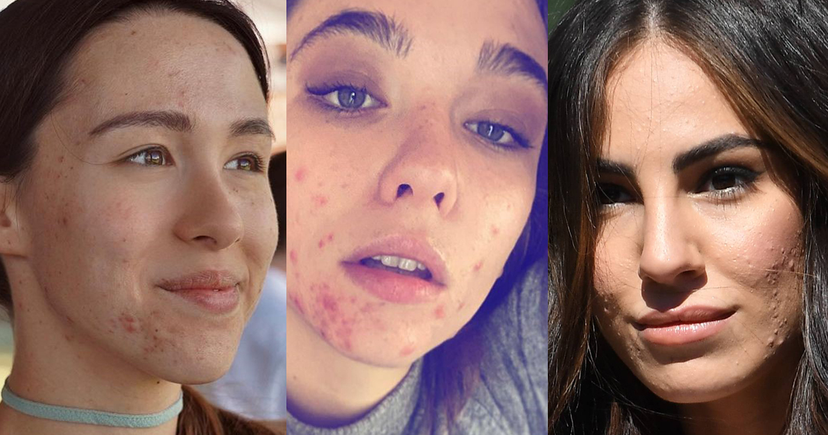 Matilda de Angelis “faccia mangiata dall’acne” contro l’insicurezza